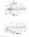 Fig. 04 - Methods for using self-retaining sutures in endoscopic procedures