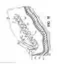 Fig. 13 - Methods for using self-retaining sutures in endoscopic procedures