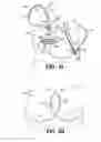Fig. 17 - Methods for using self-retaining sutures in endoscopic procedures