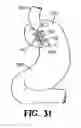 Fig. 22 - Methods for using self-retaining sutures in endoscopic procedures