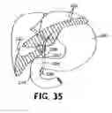 Fig. 26 - Methods for using self-retaining sutures in endoscopic procedures