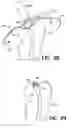 Fig. 28 - Methods for using self-retaining sutures in endoscopic procedures