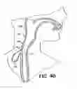 Fig. 29 - Methods for using self-retaining sutures in endoscopic procedures