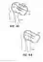 Fig. 32 - Methods for using self-retaining sutures in endoscopic procedures