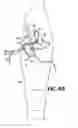 Fig. 35 - Methods for using self-retaining sutures in endoscopic procedures