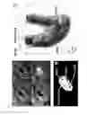 Fig. 02 - METHOD FOR CALCULATING PRESSURES IN A FLUID STREAM THROUGH A TUBE SECTION, ESPECIALLY A BLOOD VESSEL WITH ATHEROSCLEROTIC PLAQUE