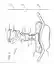 Fig. 02 - Cervical-thoracic orthotic with cervical collar