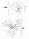 Fig. 02 - Suture with an intermediate barbed body
