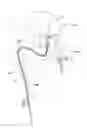 Fig. 01 - Device and method for treatment of tissue adjacent a bodily conduit by thermocompression