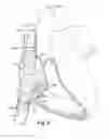 Fig. 08 - Apparatus and methods for repairing the function of a diseased valve and method for making same
