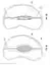 Fig. 09 - METHODS, SYSTEMS AND DEVICES FOR CARDIAC VALVE REPAIR
