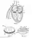 Fig. 28 - METHODS, SYSTEMS AND DEVICES FOR CARDIAC VALVE REPAIR