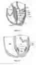 Fig. 33 - METHODS, SYSTEMS AND DEVICES FOR CARDIAC VALVE REPAIR