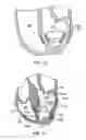 Fig. 34 - METHODS, SYSTEMS AND DEVICES FOR CARDIAC VALVE REPAIR