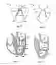Fig. 40 - METHODS, SYSTEMS AND DEVICES FOR CARDIAC VALVE REPAIR