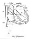 Fig. 02 - ACCESS TO THE LEFT ATRIUM AND REDUCTION OF MITRAL VALVE LEAFLET MOBILITY