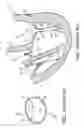 Fig. 04 - ACCESS TO THE LEFT ATRIUM AND REDUCTION OF MITRAL VALVE LEAFLET MOBILITY