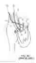 Fig. 06 - ACCESS TO THE LEFT ATRIUM AND REDUCTION OF MITRAL VALVE LEAFLET MOBILITY