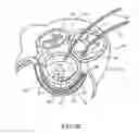 Fig. 08 - ACCESS TO THE LEFT ATRIUM AND REDUCTION OF MITRAL VALVE LEAFLET MOBILITY