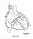 Fig. 09 - ACCESS TO THE LEFT ATRIUM AND REDUCTION OF MITRAL VALVE LEAFLET MOBILITY