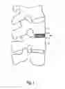 Fig. 02 - Intervertebral Disc Implant