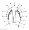 Fig. 01 - Method of implanting an implant including bone abrasion