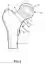 Fig. 04 - Joint prosthesis