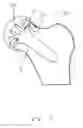 Fig. 08 - Joint prosthesis