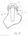 Fig. 09 - Joint prosthesis