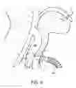 Fig. 06 - Tracheostomy Tube