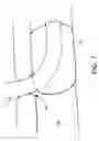 Fig. 07 - Tracheostomy Tube