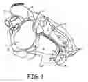 Fig. 02 - Delivery catheter