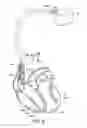 Fig. 09 - System and method for detecting pulmonary edema based on impedance measured using an implantable medical device during a lead maturation interval