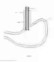 Fig. 03 - Gastric Simulation Anchor and Method