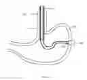 Fig. 04 - Gastric Simulation Anchor and Method