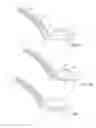Fig. 12 - Gastric Simulation Anchor and Method