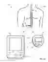 Fig. 02 - Collecting posture information to evaluate therapy