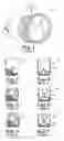Fig. 02 - Stented prosthetic heart valves
