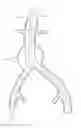Fig. 01 - LOW-PROFILE MODULAR ABDOMINAL AORTIC ANEURYSM GRAFT