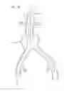 Fig. 03 - LOW-PROFILE MODULAR ABDOMINAL AORTIC ANEURYSM GRAFT