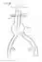 Fig. 04 - LOW-PROFILE MODULAR ABDOMINAL AORTIC ANEURYSM GRAFT