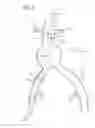 Fig. 09 - LOW-PROFILE MODULAR ABDOMINAL AORTIC ANEURYSM GRAFT