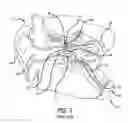 Fig. 04 - System and method for treatment of non-ventilating middle ear by providing a gas pathway through the nasopharynx