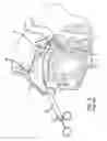 Fig. 06 - System and method for treatment of non-ventilating middle ear by providing a gas pathway through the nasopharynx