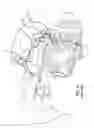 Fig. 07 - System and method for treatment of non-ventilating middle ear by providing a gas pathway through the nasopharynx