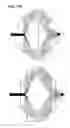 Fig. 49 - Reflective axicon systems and methods