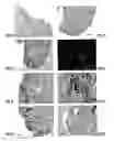 Fig. 09 - METHOD FOR DIAGNOSIS OF INFLAMMATORY DISEASES USING CALGRANULIN C