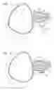 Fig. 02 - PROSTATIC TISSUE REMOVAL AND/OR PROSTATIC CAPSULOTOMY FOR TREATMENT OF CONDITIONS