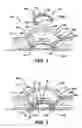 Fig. 02 - Methods and devices for accessing a body cavity using a surgical access device with modular seal components