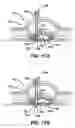 Fig. 12 - Methods and devices for accessing a body cavity using a surgical access device with modular seal components